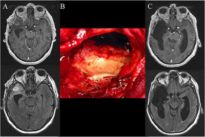 Surgery for Malignant Brain Gliomas: Fluorescence-Guided Resection or Functional-Based Resection?